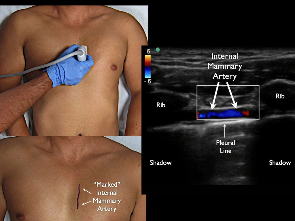 1) If effusion very midline, locate the mammary arteries with Linear Probe (optional)