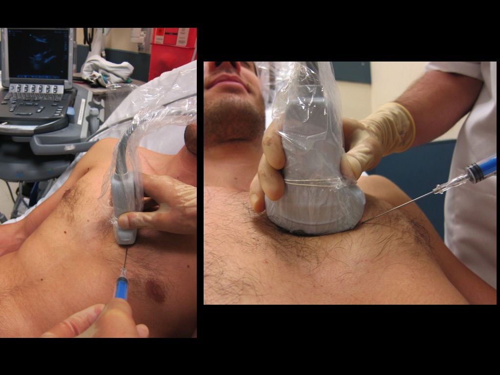 1) Ultrasound screen in field of view 2) Local anesthetic in skin and muscle 3) Low dose etomidate or ketamine just before entering pericardial sac 4) In-plane with needle visualization