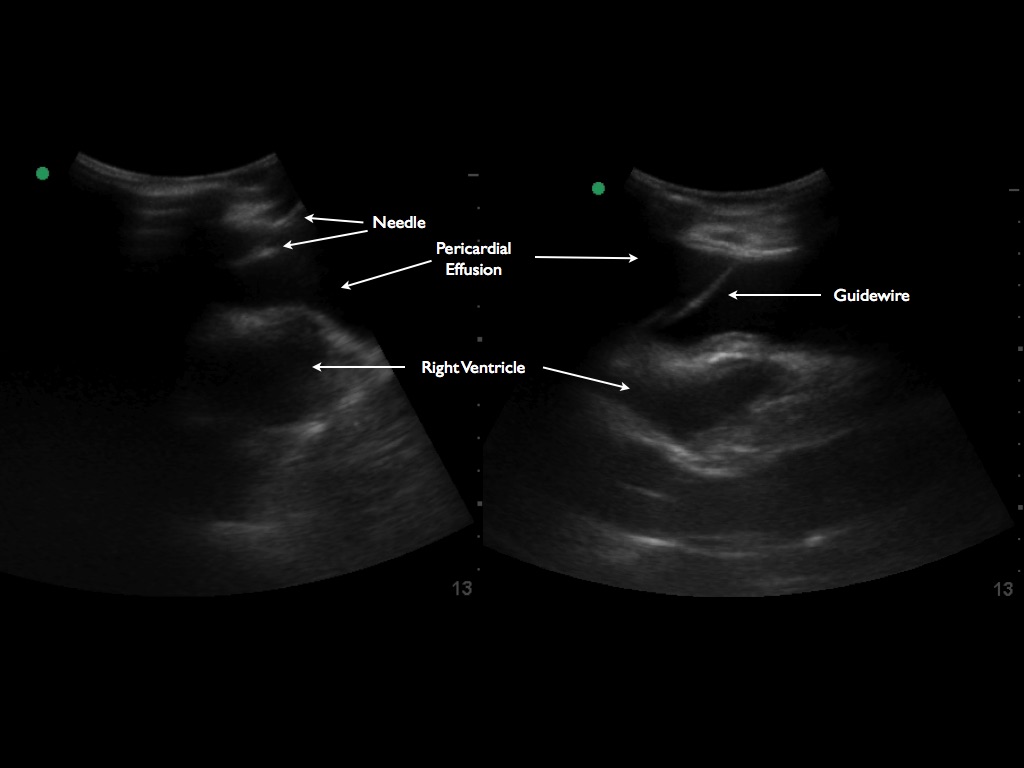 1) Visualize the guidewire to confirm placement