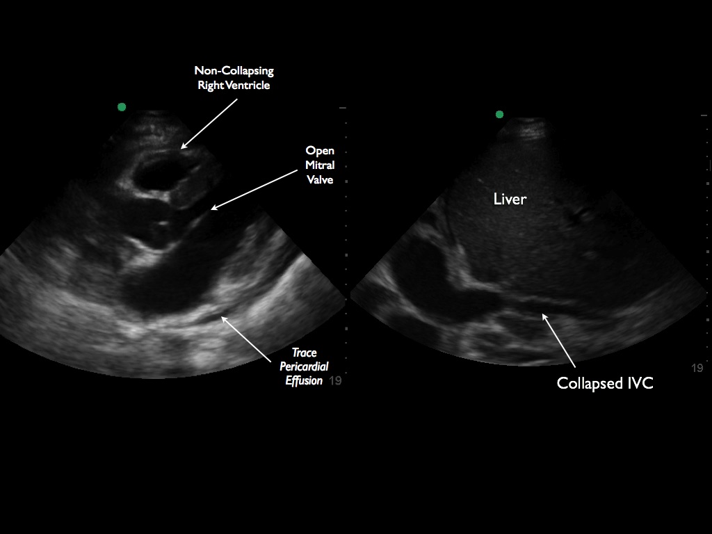 1) Drain effusion 2) Confirm reduction in pericardial effusion and IVC collapse