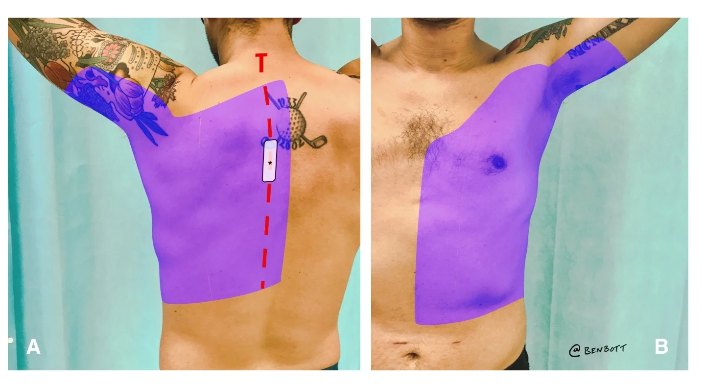 Erector Erector Spinae Plane Block Procedure Guide – CBPG