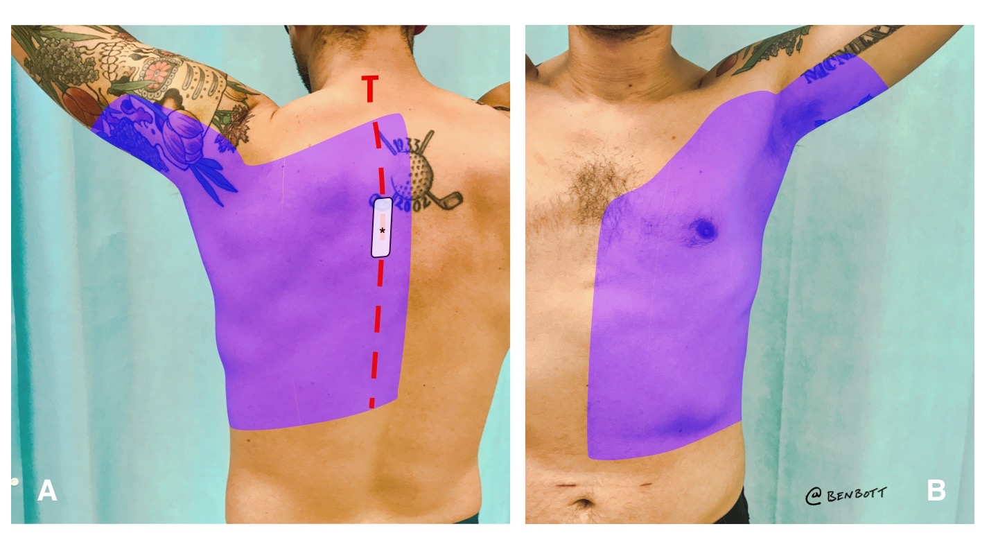 Nysora Erector Spinae Block : Erector spinae plane block: the ultimate ...