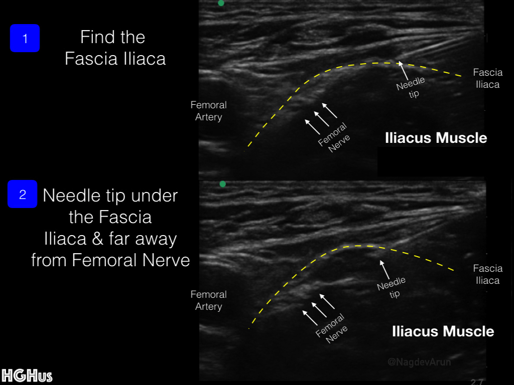 Infrainguinal Fascia Iliaca Plane Block ( AKA : Femoral Nerve Block ...