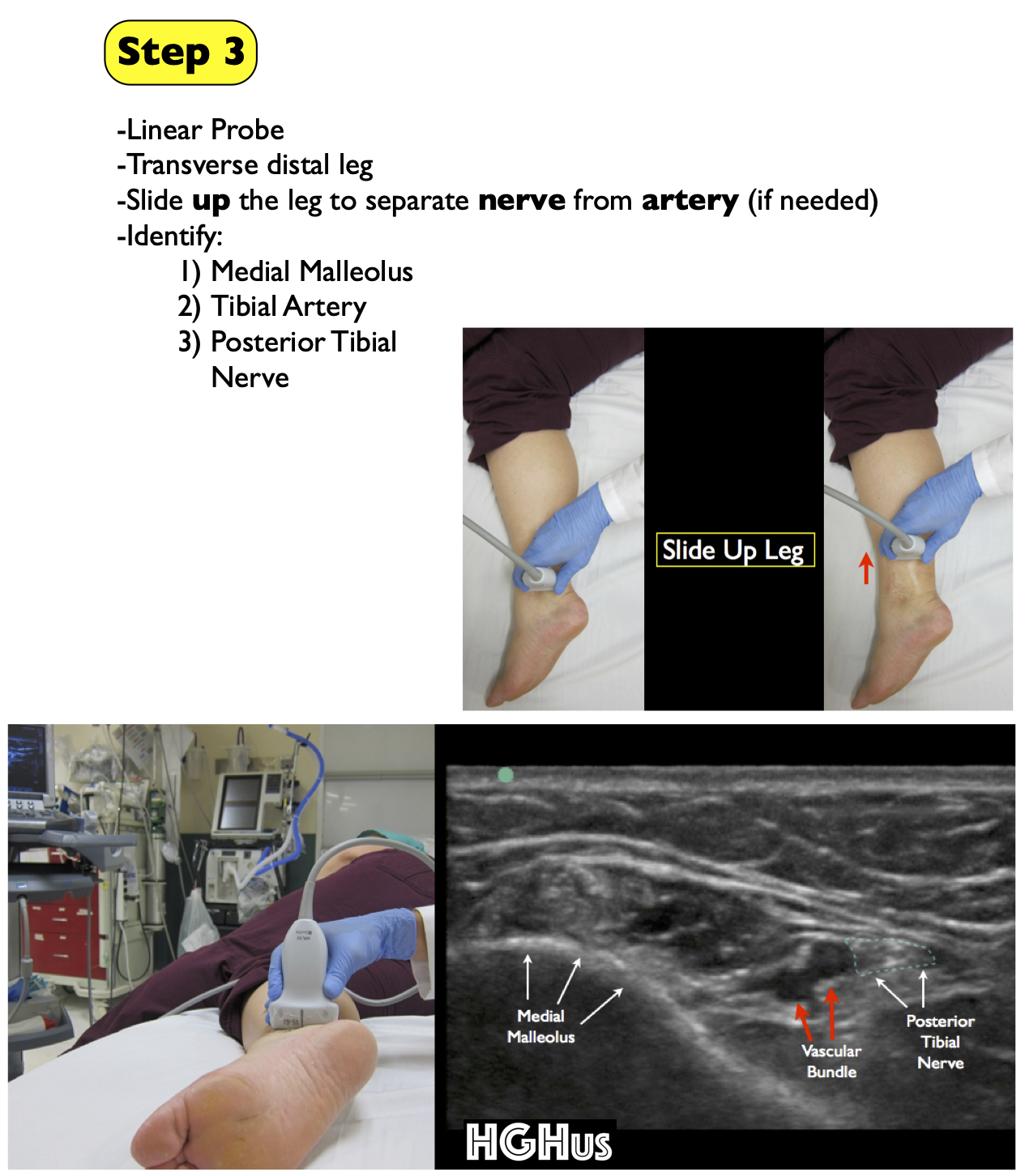 Tibial — Highland Em Ultrasound Fueled Pain Management