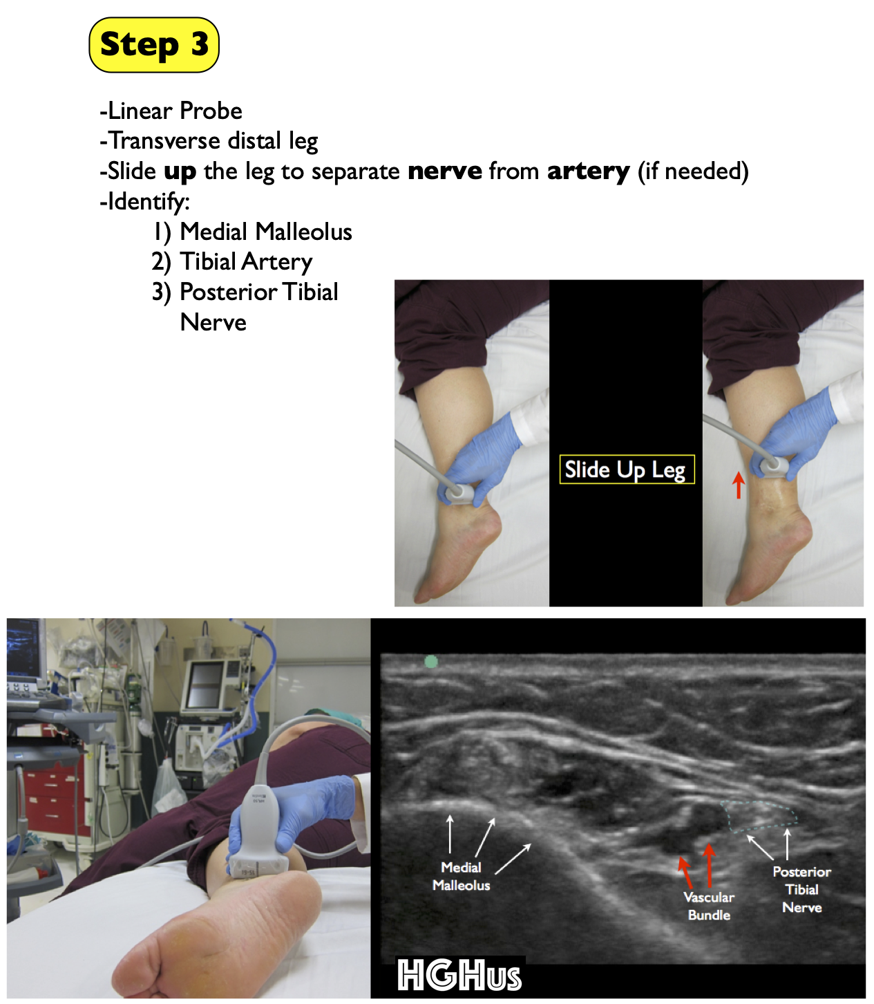 Posterior Tibial Tendon Ultrasound