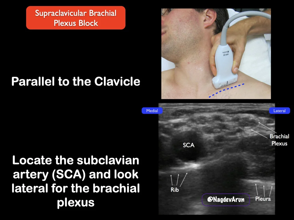 Supraclavicular Brachial Plexus — Highland EM Ultrasound Fueled pain