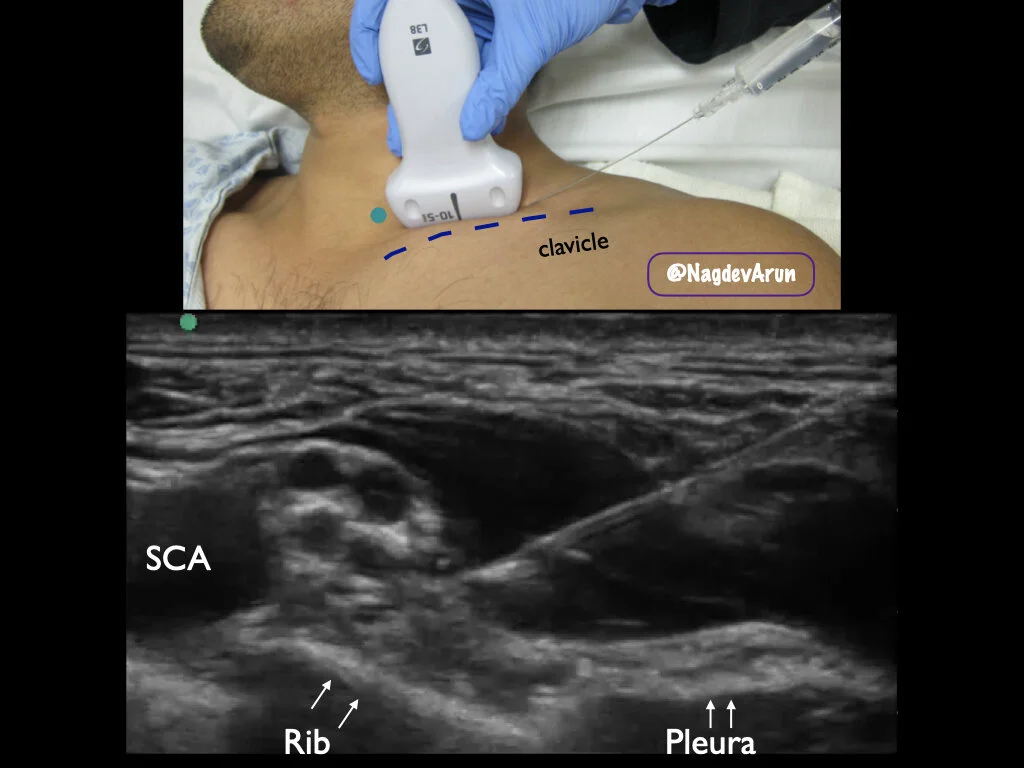 Supraclavicular Brachial Plexus — Highland EM Ultrasound Fueled pain