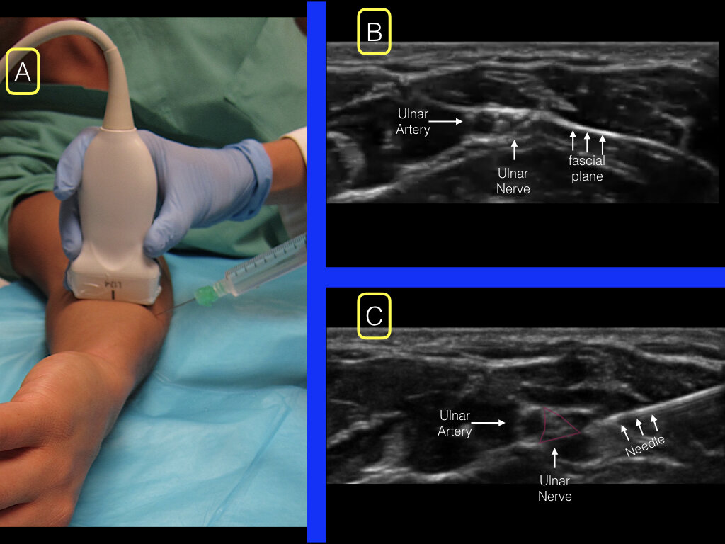 Forearm Blocks — Highland Em Ultrasound Fueled Pain Management