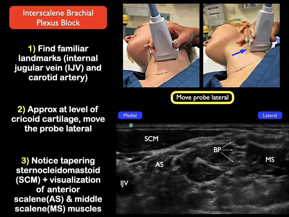 Interscalene — Highland EM Ultrasound Fueled pain management
