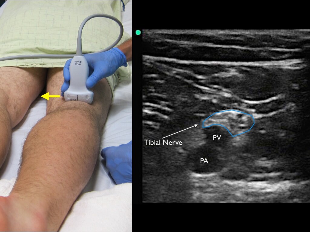 Popliteal Block Side Effects | Nerve Block: What It Is, Procedure, Side ...