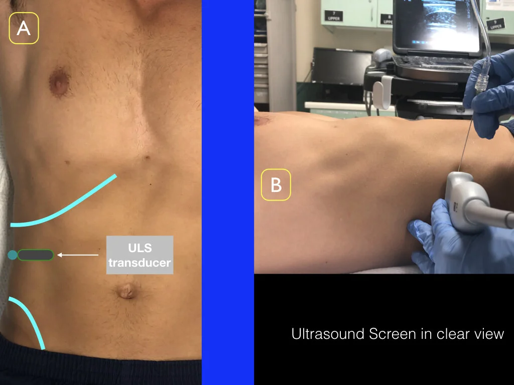 TAP Block - Transverse Abdominus Plane Block — Highland EM Ultrasound ...