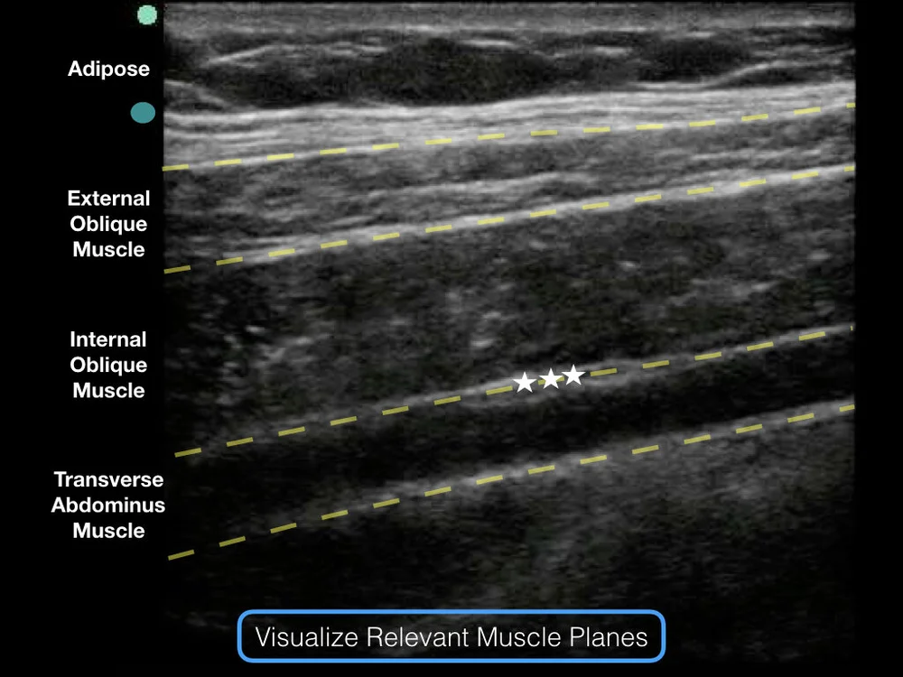 Transverse Blocking TAP Block - Transverse Abdominus Plane Block — Highland EM Ultrasound ...