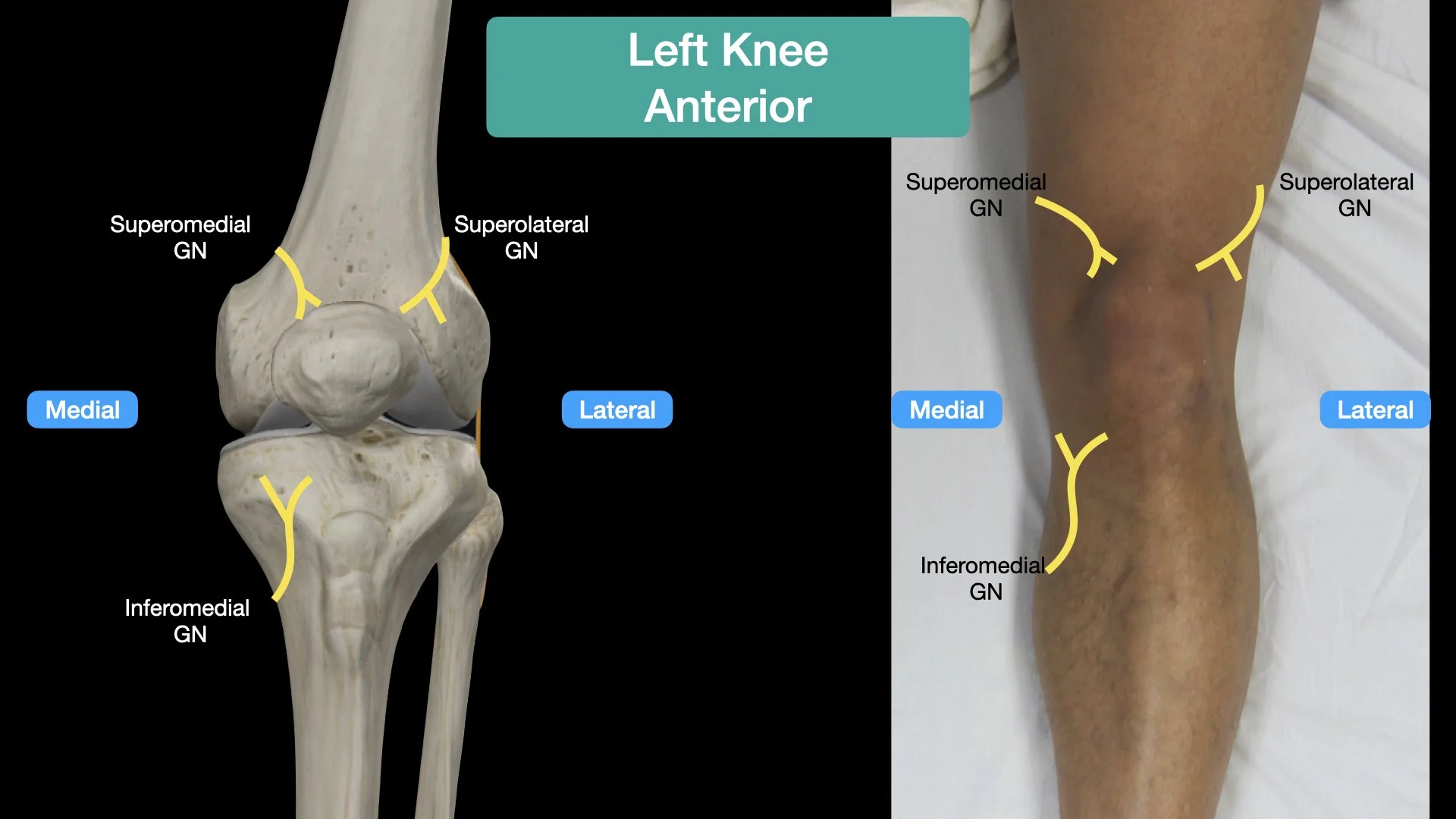 Genicular Nerve Block — Highland EM Ultrasound Fueled pain management