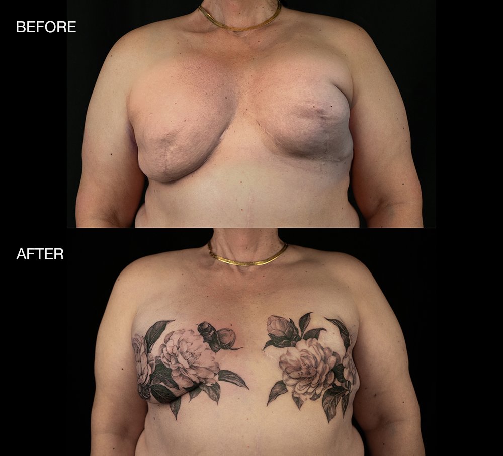 Mastectomy tattoo transformation by David Allen