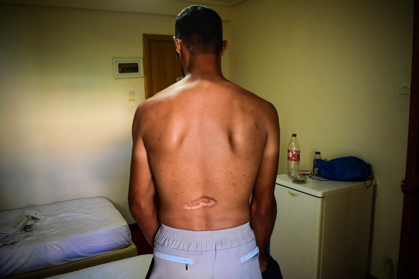 A Syrian asylum-seeker in Greece, who was tortured before the war and has a scar from a bullet that hit him during an attack in Syria.