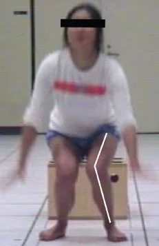  This is a valgus collapse.  Yes, it looks as bad as it sounds. 