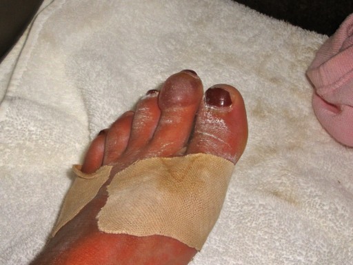 A fun blister from the nail being forced back, should have smoothed that one....jpg