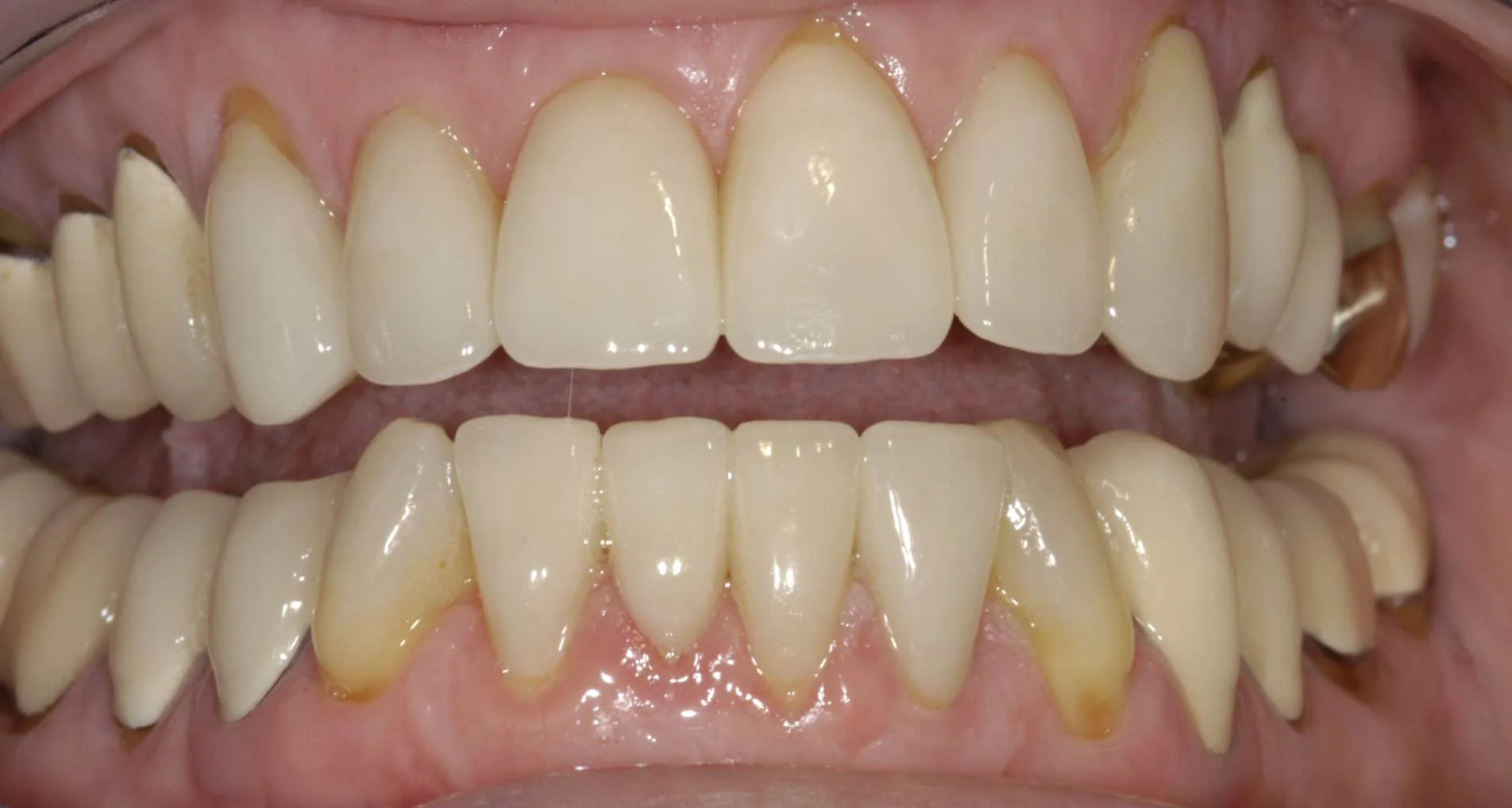 After restorative treatment.