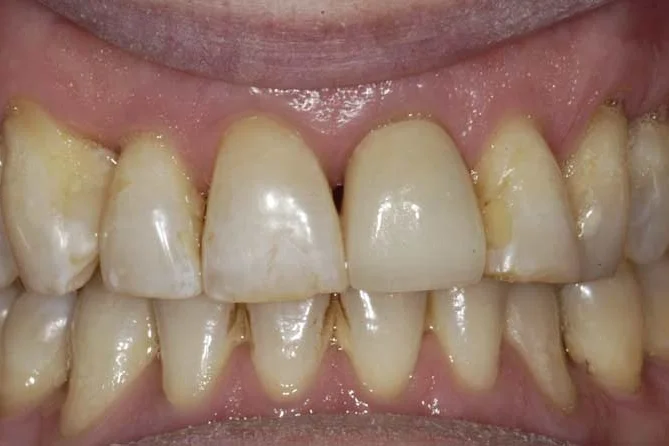 After restoration of upper front tooth.