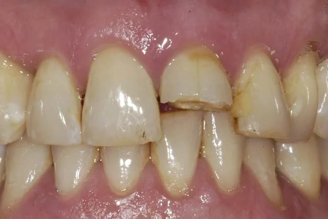 Accidental fracture of an upper front tooth.