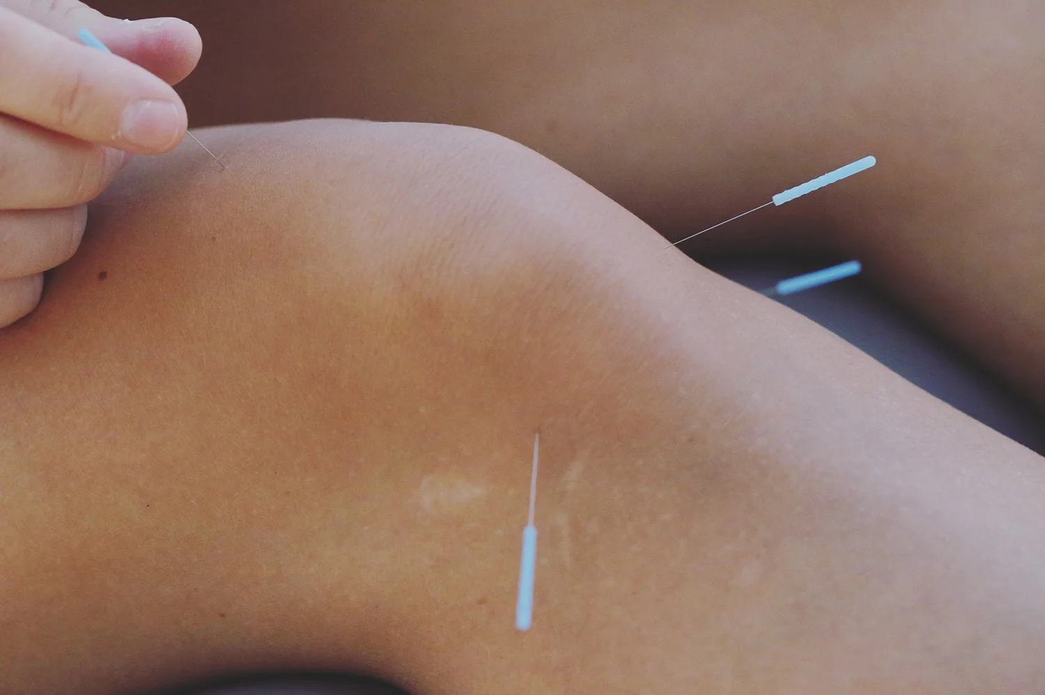 red-bank-acupuncture.jpg