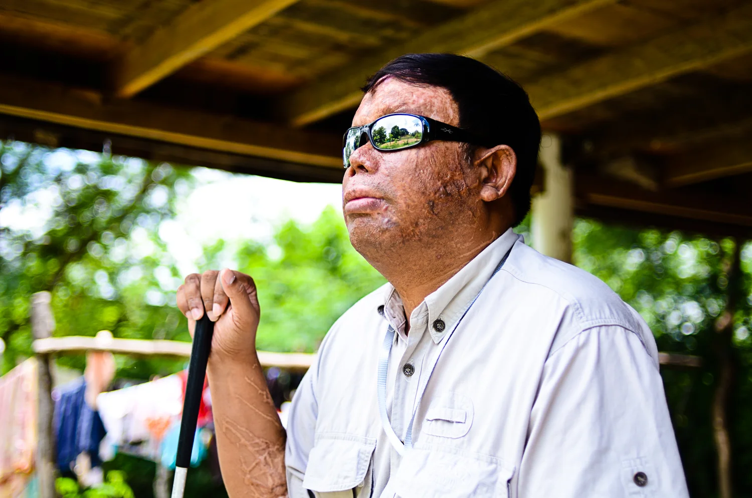 Acid violence in Cambodia