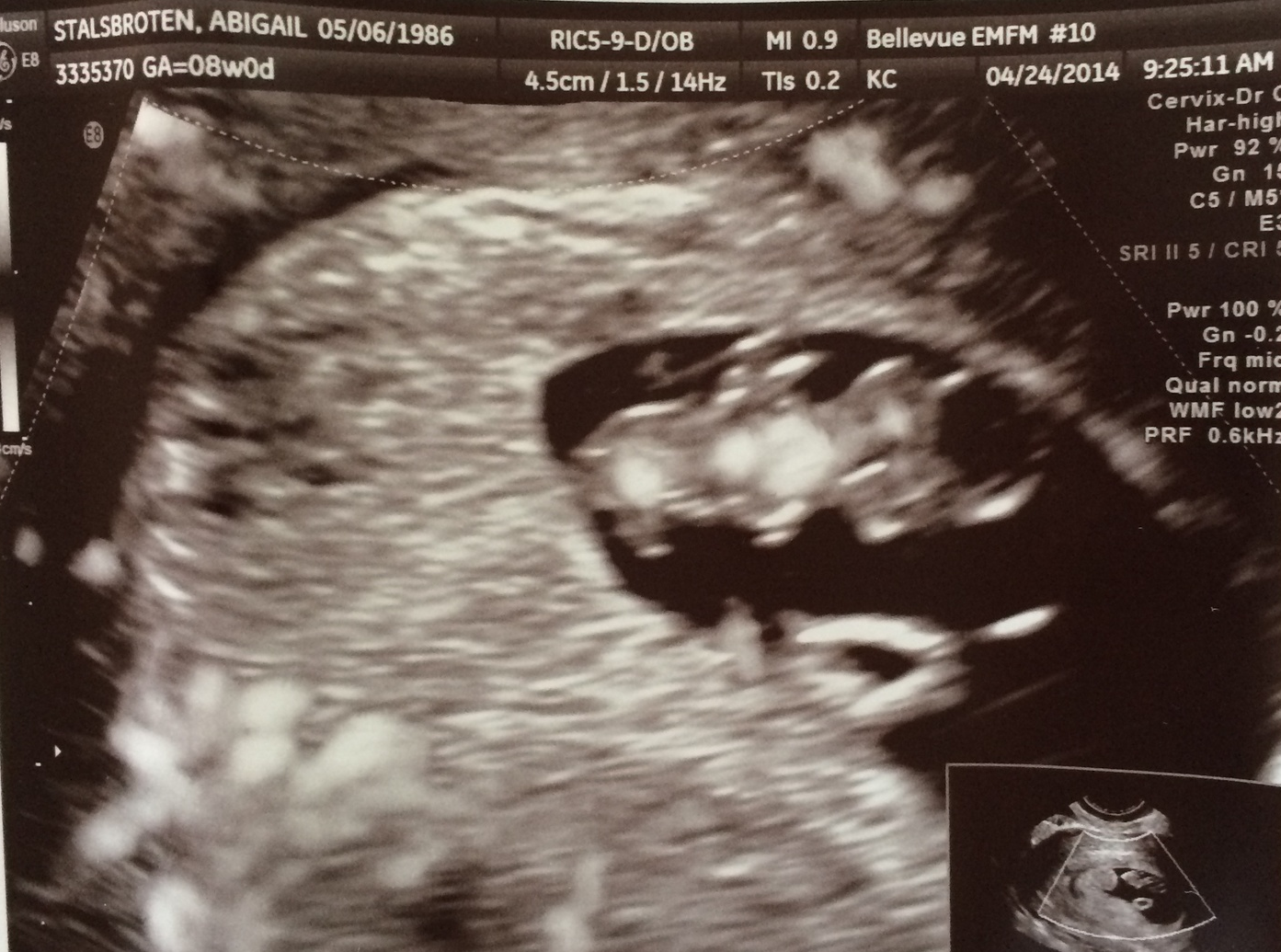 8 week ultrasound — hearing the heartbeat for the first time was so reassuring. Can you see the little frog on the right side? That's her!