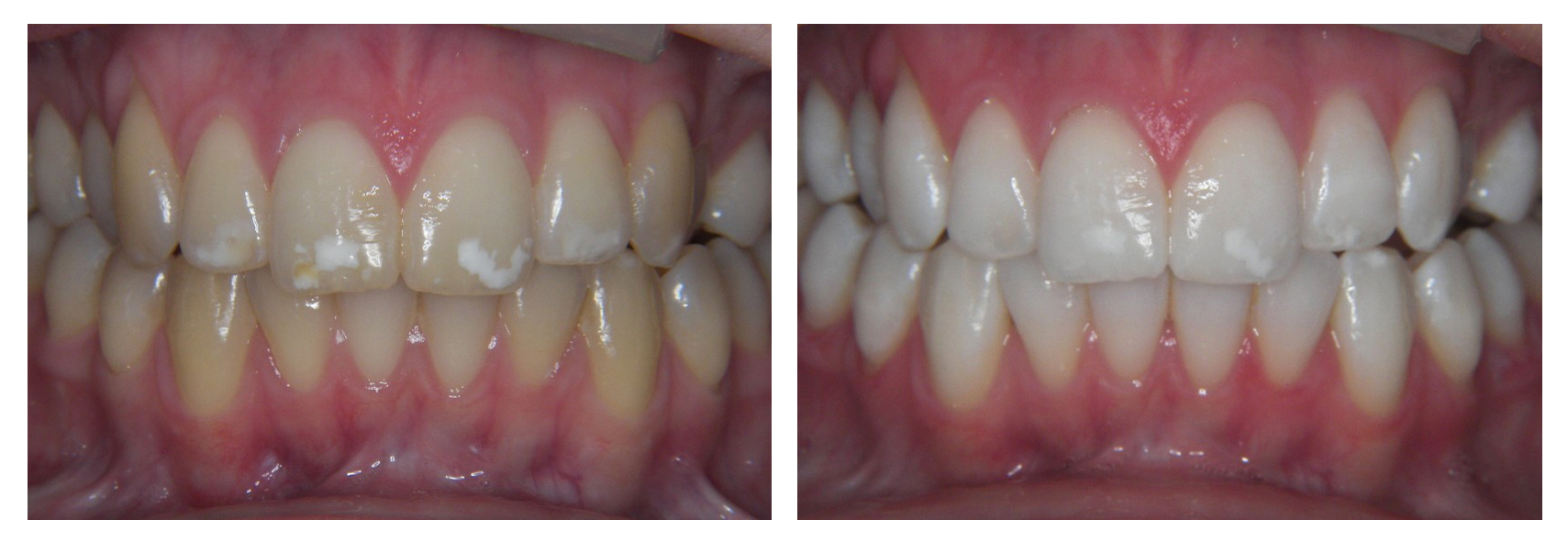 Enlighten Tooth Whitening