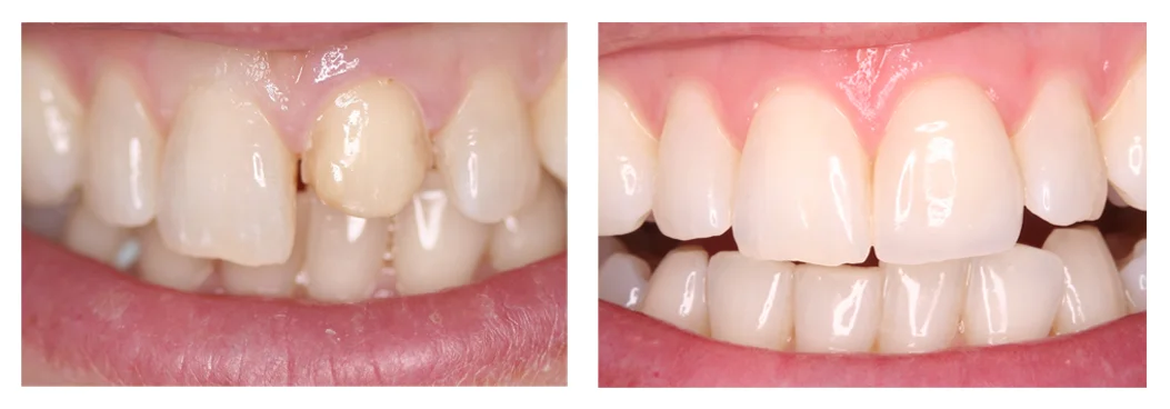 Copy of Porcelain Veneer