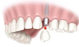 Implant Picture