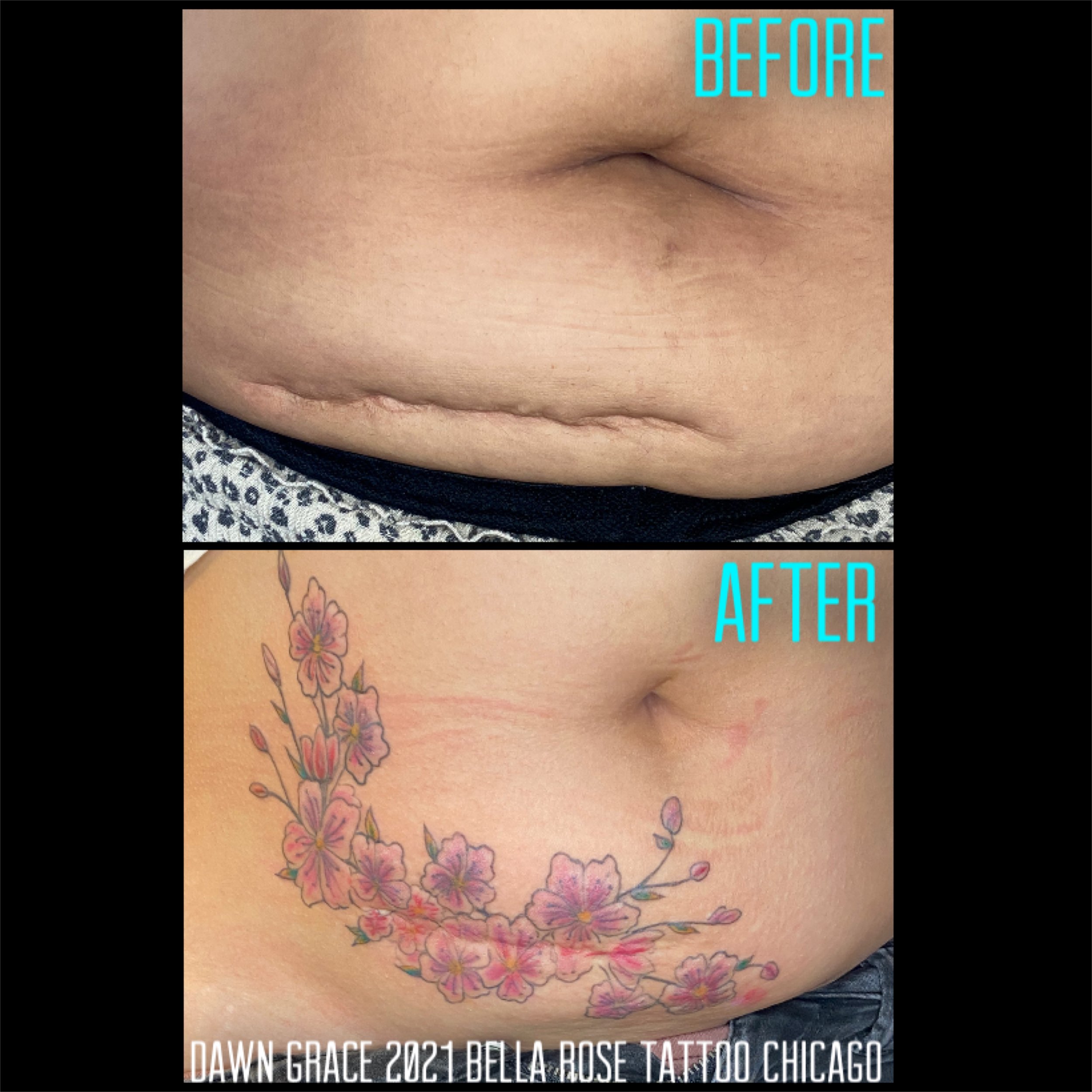 Medical Camouflage for Stretch Mark and Scars Duluth GA  Bella Forma