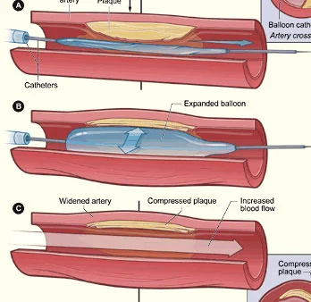 Angioplasty in Manila