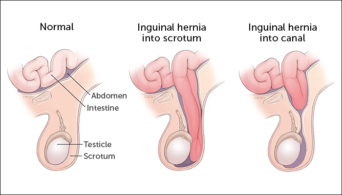 InguinalHernia.png