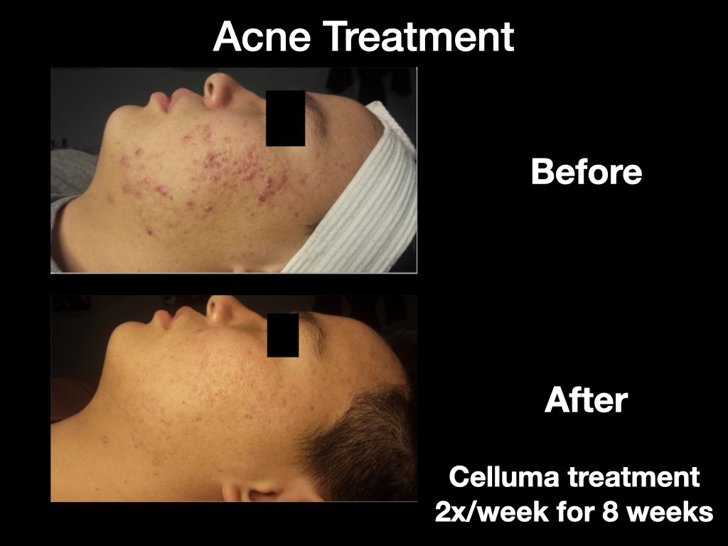 Acne 2 before and after.jpeg