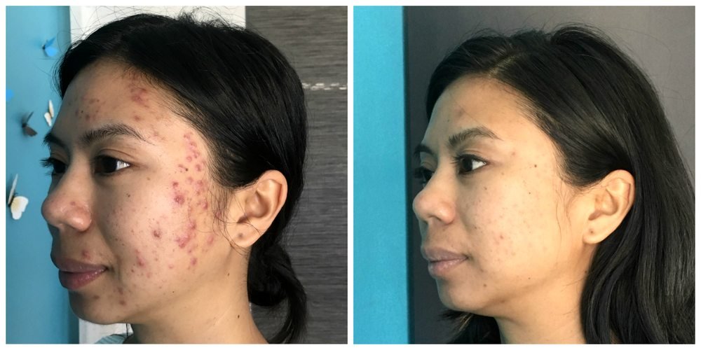 Before & After - acne side view.jpeg