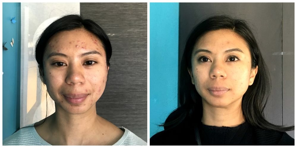 Before & After - acne fwd view.jpeg