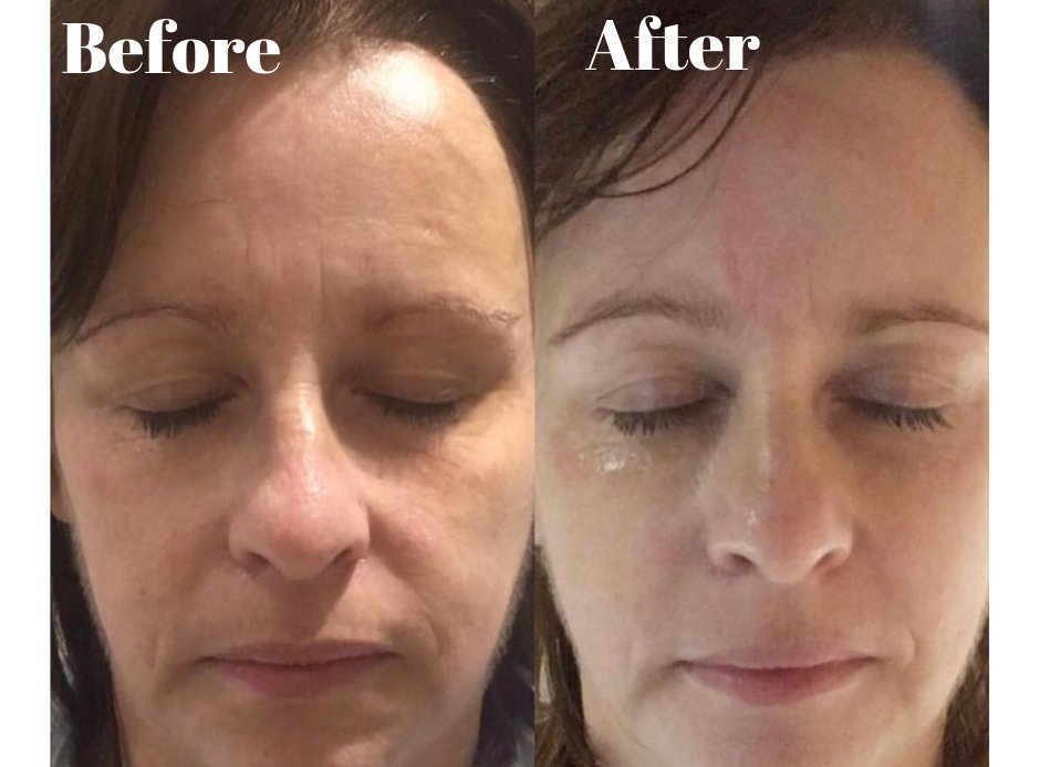 Before & After - Acu face lift.jpeg