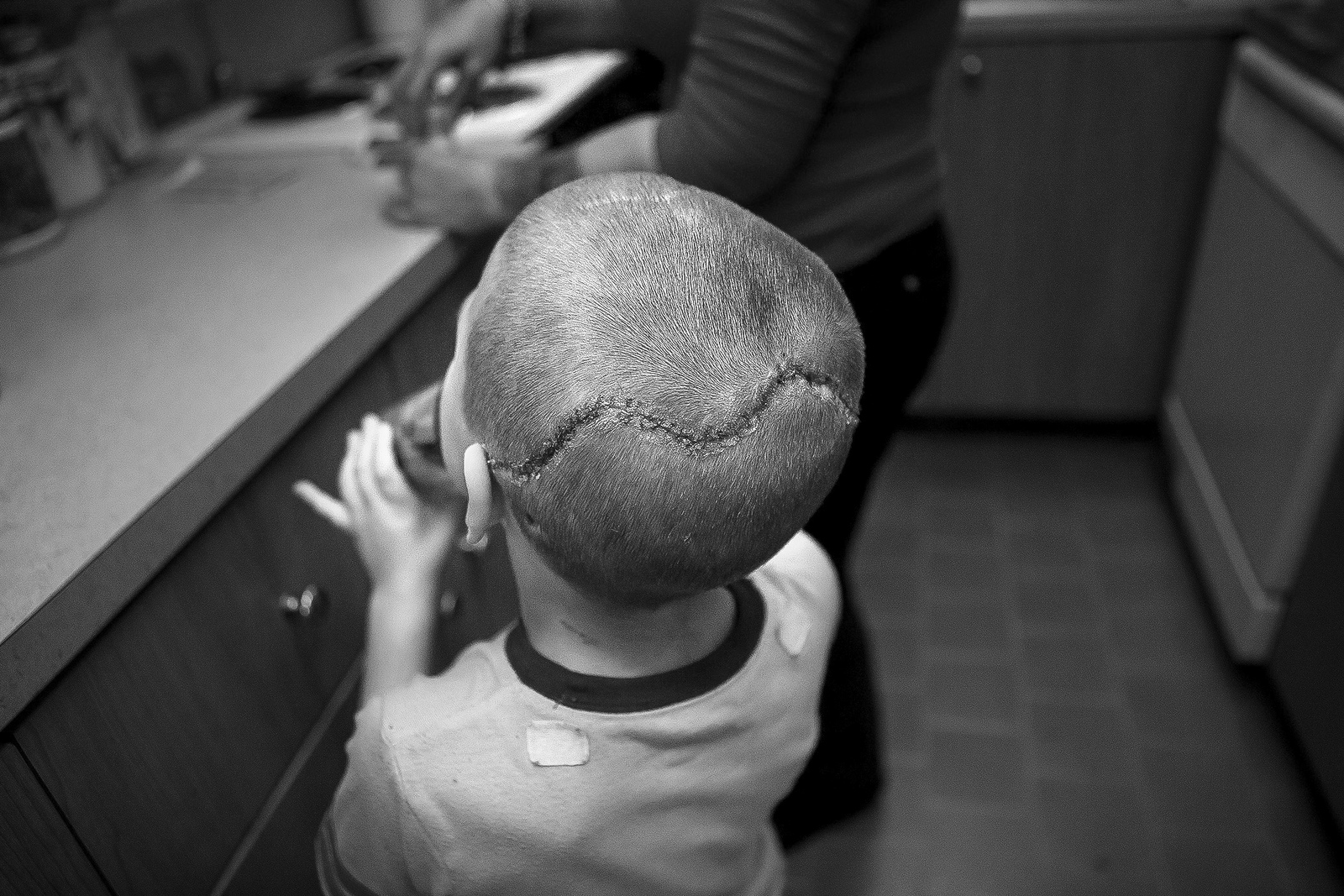 Jacob Gutierrez, 4, swallows medicine from his mother after undergoing a series of major skull surgeries. When Jacob was a baby, he had to wear a helmet, but his family hopes that this will be the last surgery he will need to correct his craniosynos