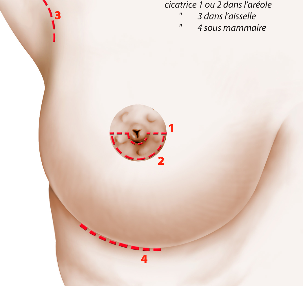incisions-cicatrices.png