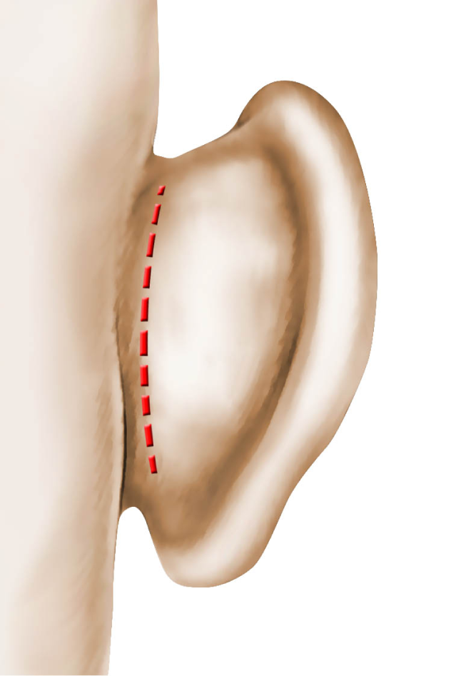 chirurgie-des-oreilles-decollees.png