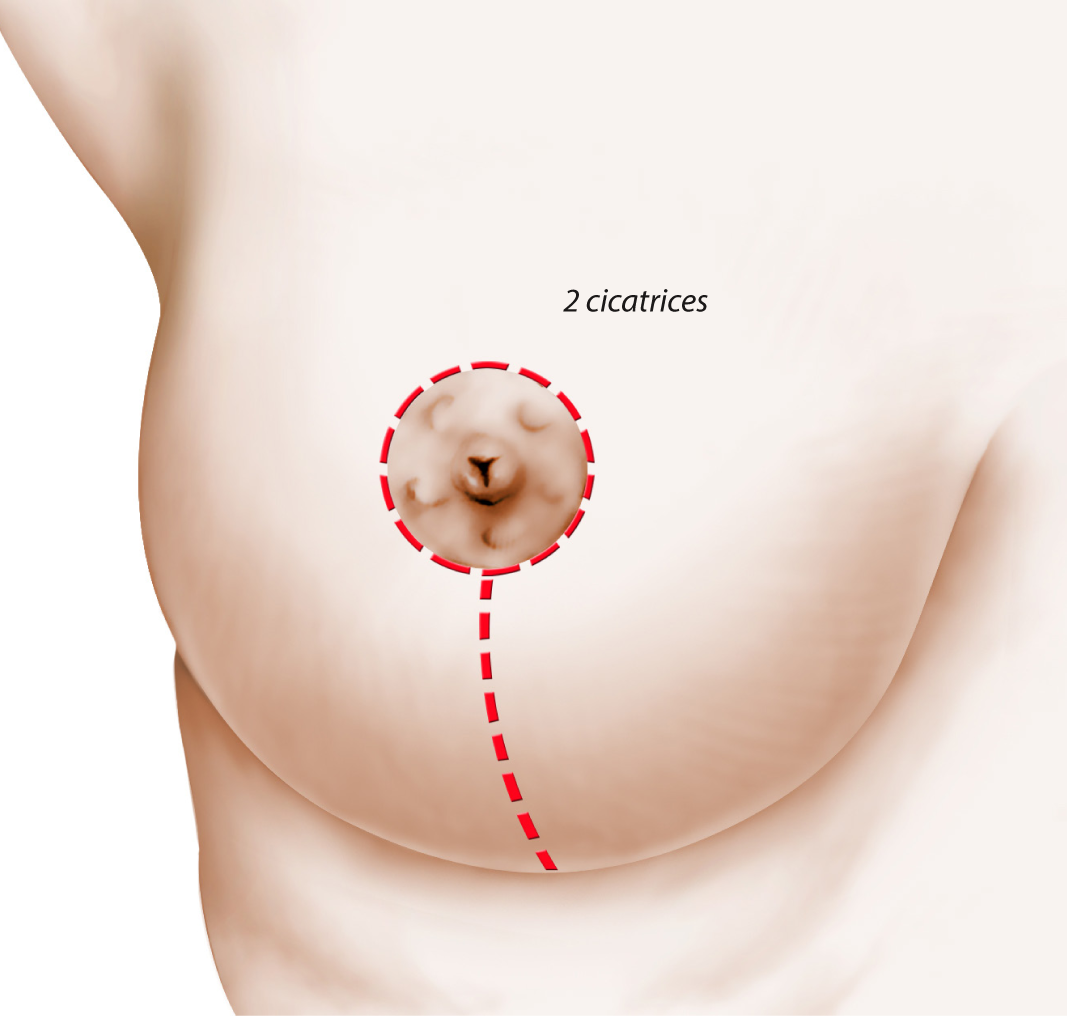 incisions-mammaires-2.png