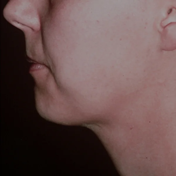 après, rétraction cutanée par lipolyse laser