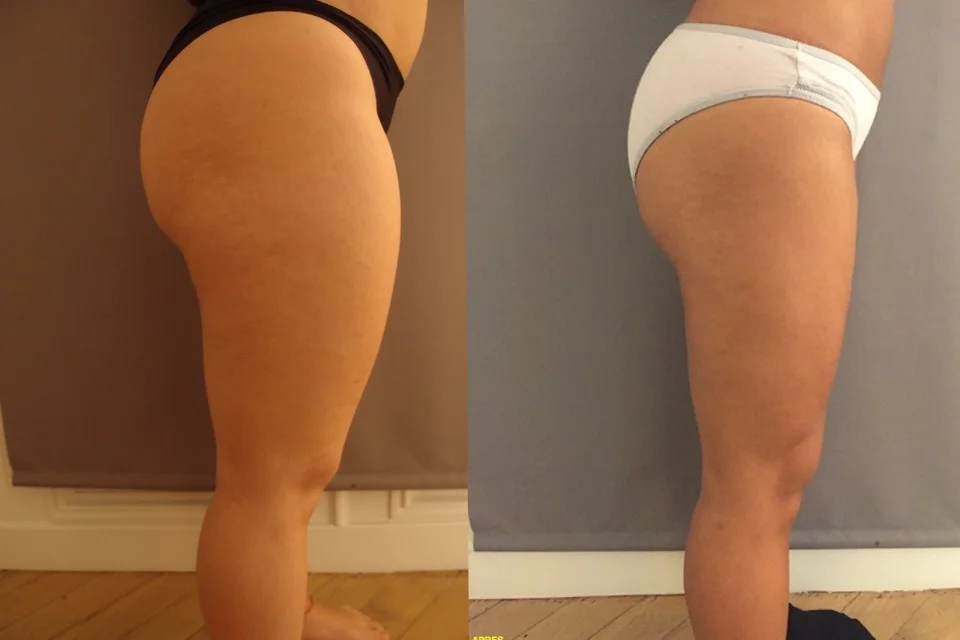 Quand a liposuccion aide à maigrir…