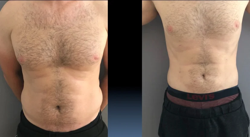 Sculpture des abdominaux, à droite le résultat à six mois