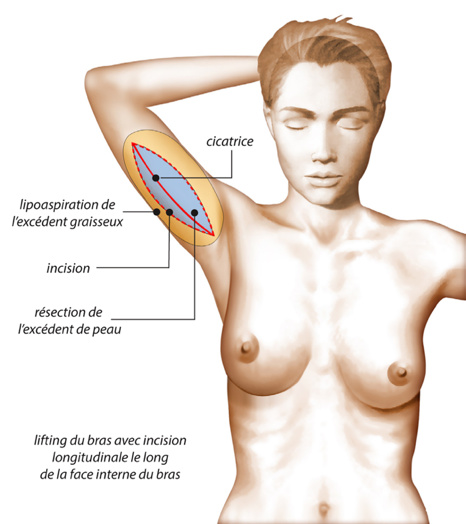 Lifting-du-bras_1.png