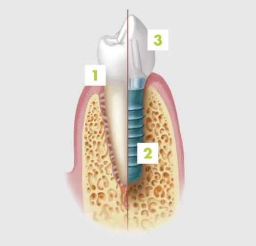 1 - natural tooth | 2 - dental implant | 3 - implant crown