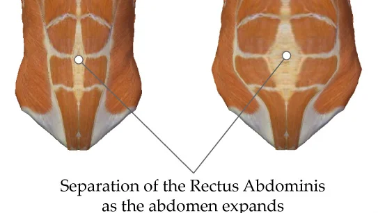 abdominis-diastises.jpg