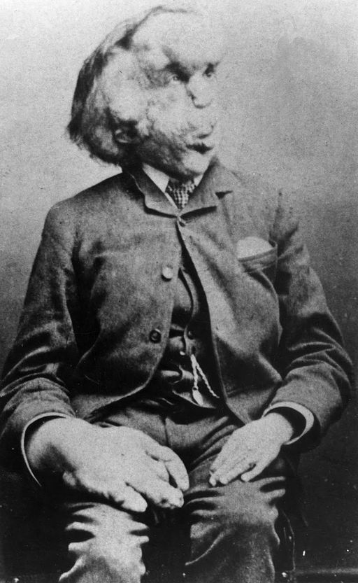 Joseph Merrick, the ‘Elephant Man’.