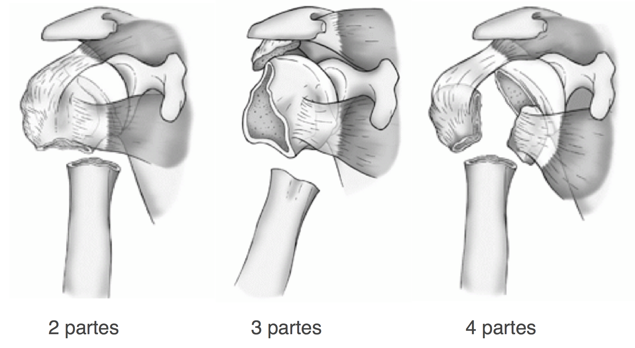 Diferentes partes da fratura