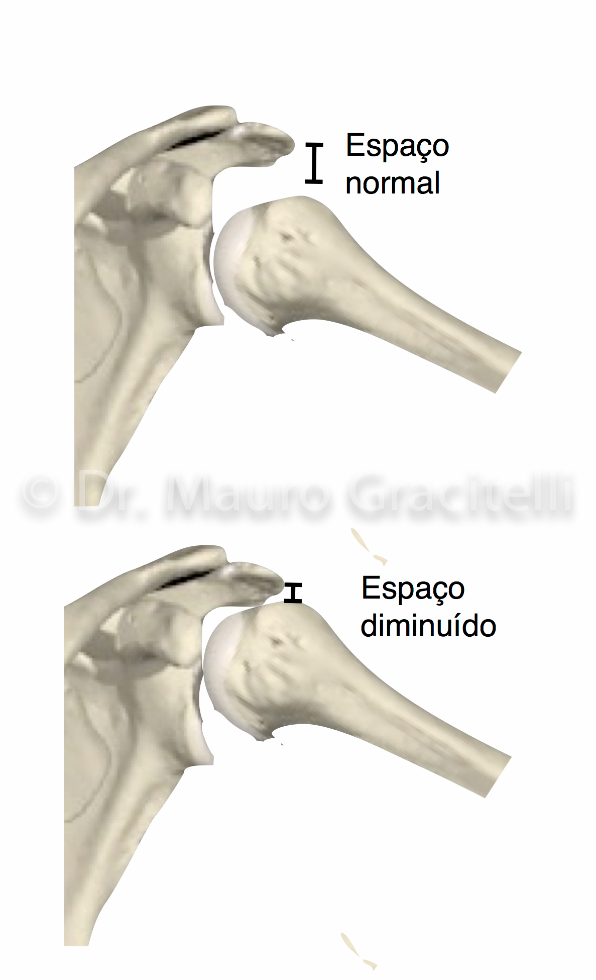 Anatomia do Ombro - Tendões do manguito rotador e bursa subacromial — Dr.  Mauro Gracitelli